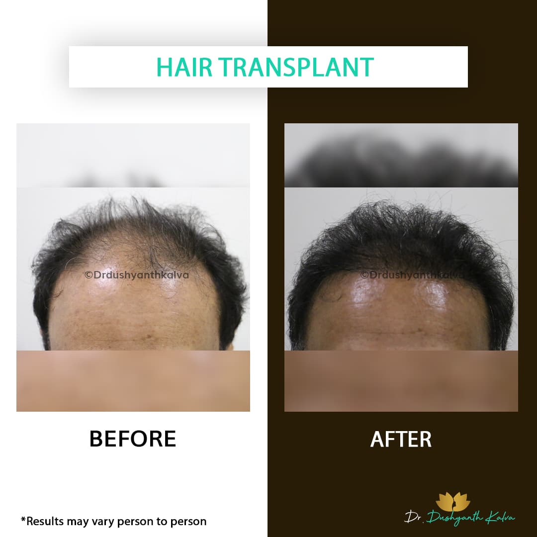 Hair Transplant