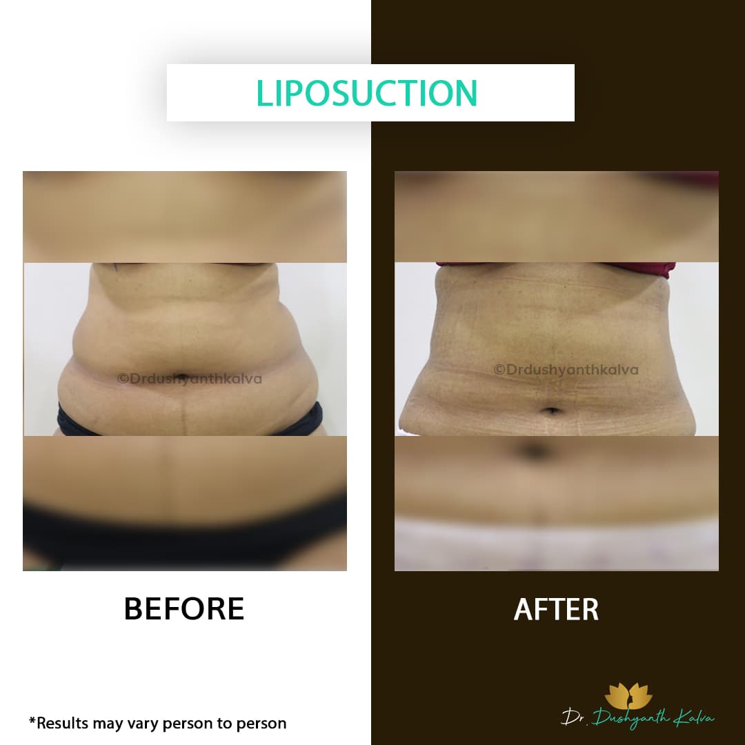 Liposuction