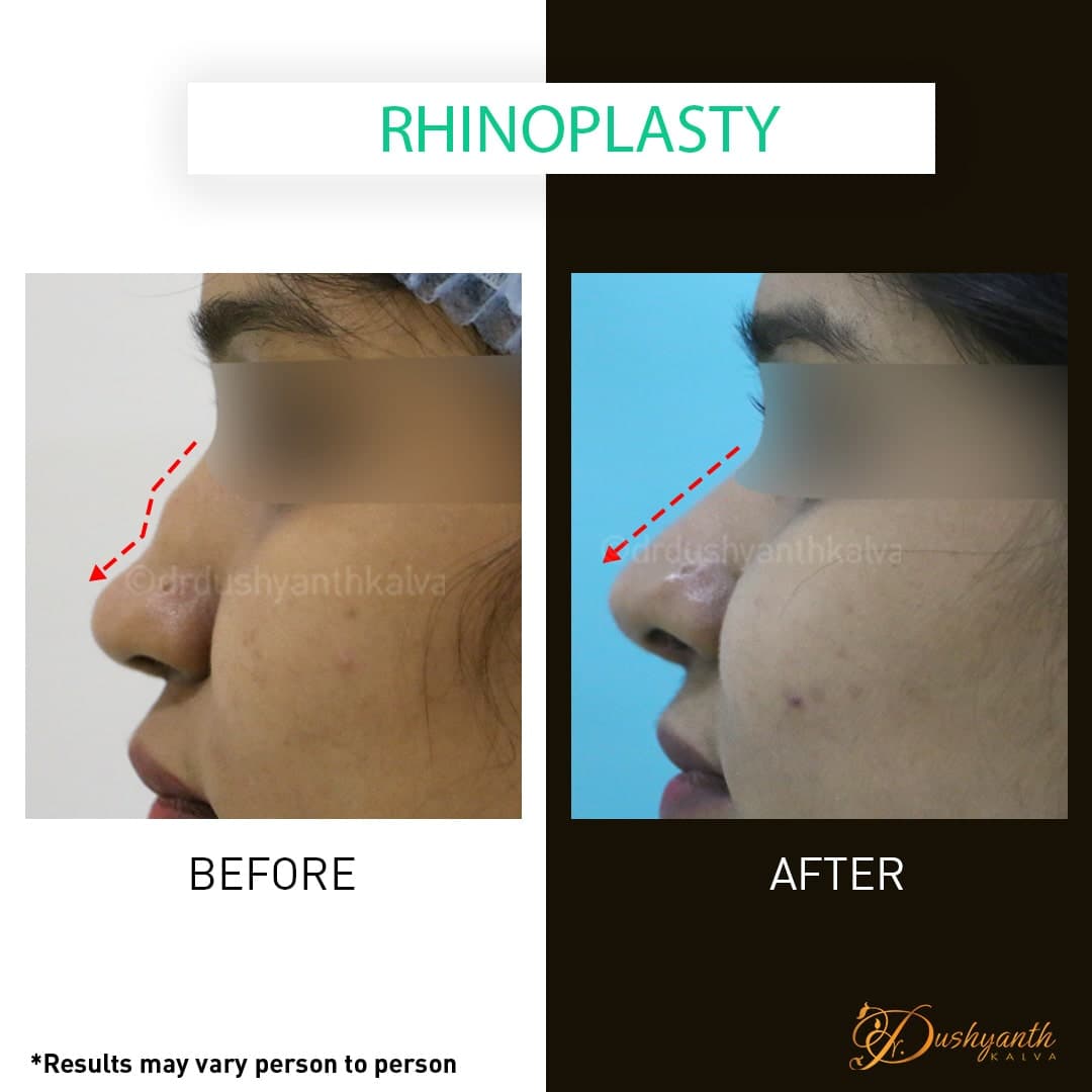 Rhinoplasty before and after result 05
