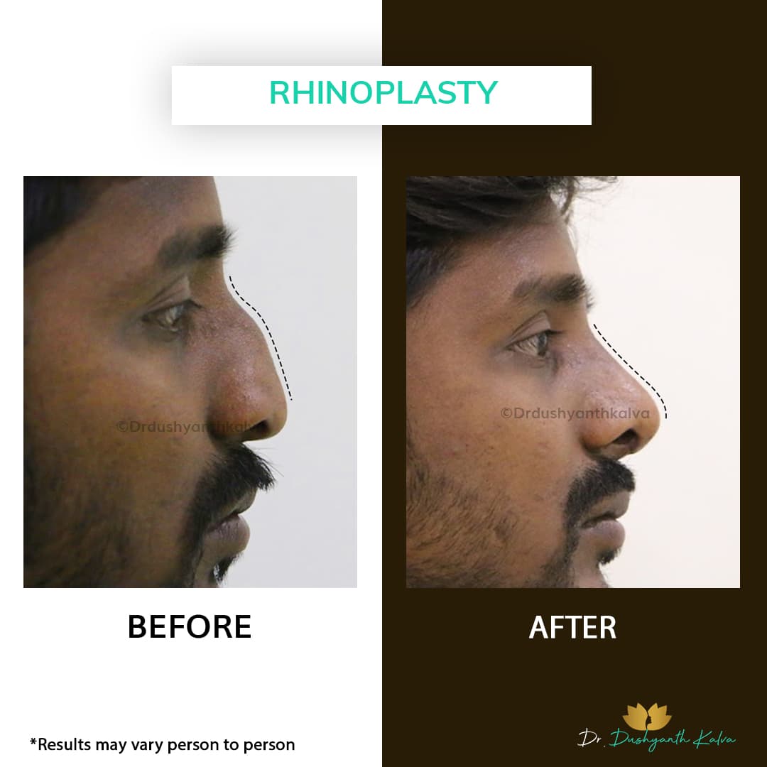 Rhinoplasty before and after result 03