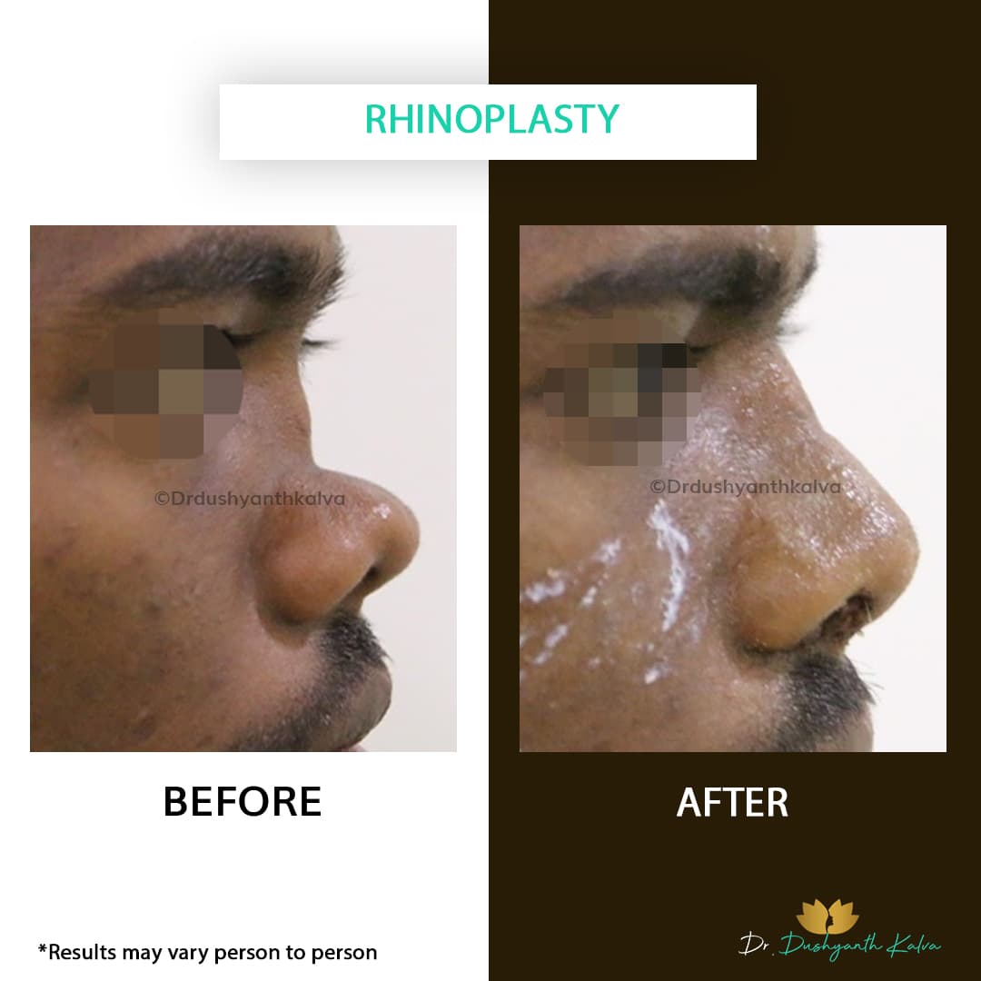 Rhinoplasty before and after result 01