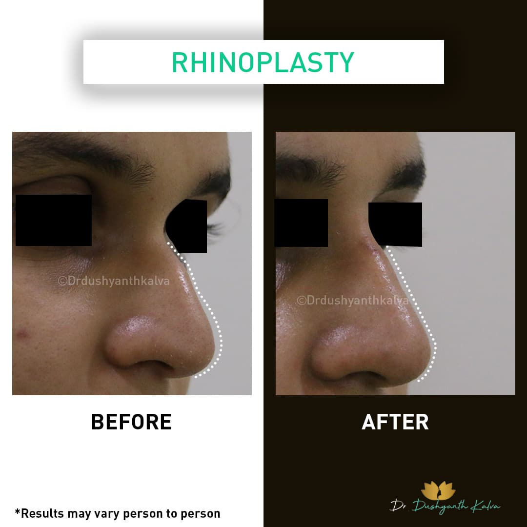 Rhinoplasty before and after result 04